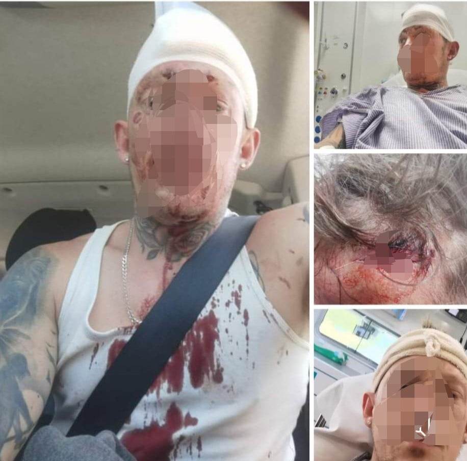 Dispute Turns Violent as Man Suffers Skull Fracture in Brutal Hammer Attack in Weymouth